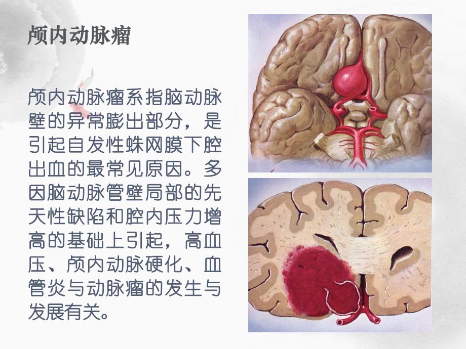 动脉瘤病人护理查房.ppt_第2页