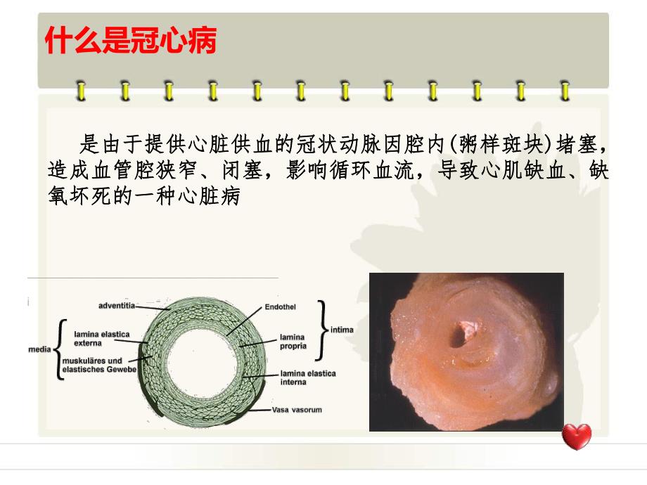 冠心病的介入治疗3.ppt_第2页