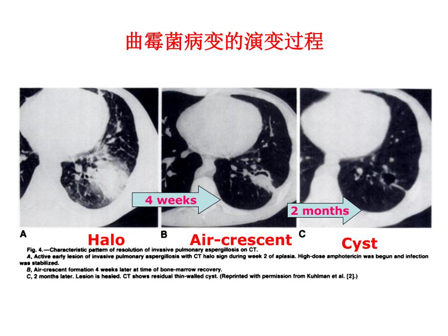 医院肺真菌病的影像诊断4.ppt_第3页