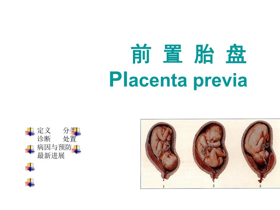 前置胎盘[精彩].ppt_第3页