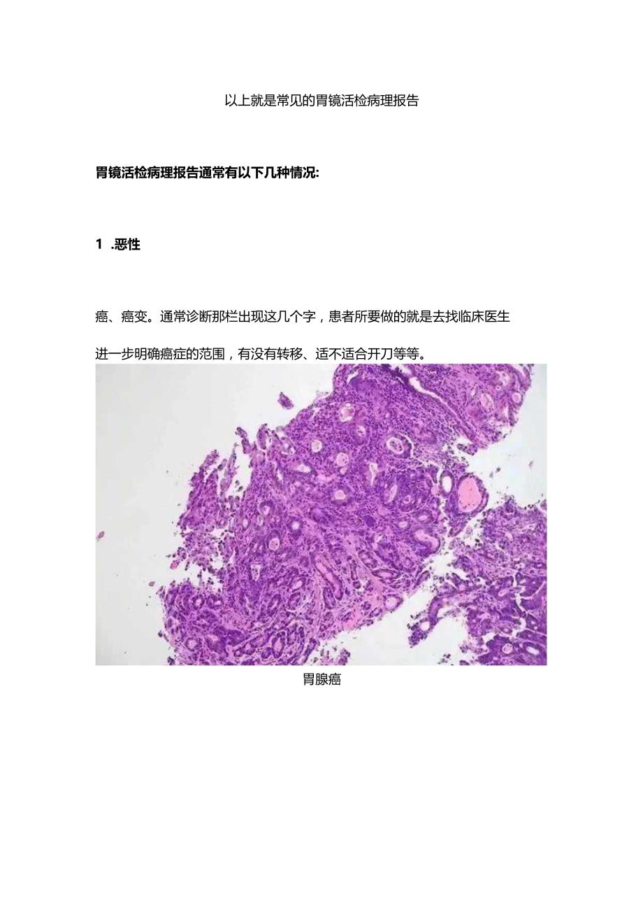 2024胃镜活检病理报告.docx_第2页