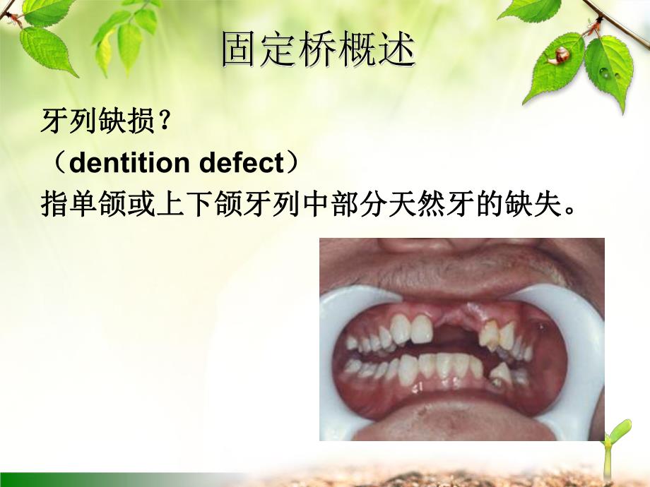 口腔修复学第五章 固定桥.ppt_第3页