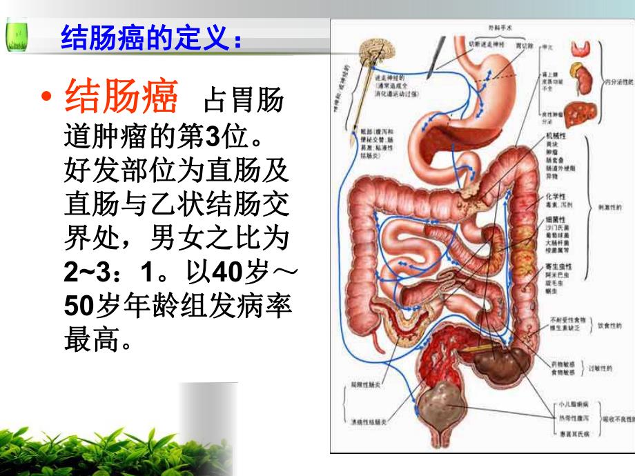 乙状结肠癌护理查房.ppt_第2页