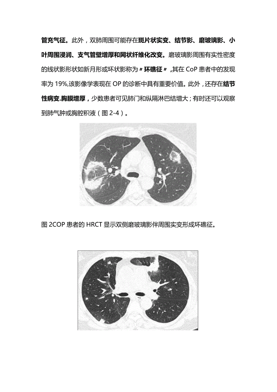 隐源性机化性肺炎的临床特征和诊断要点2024.docx_第3页