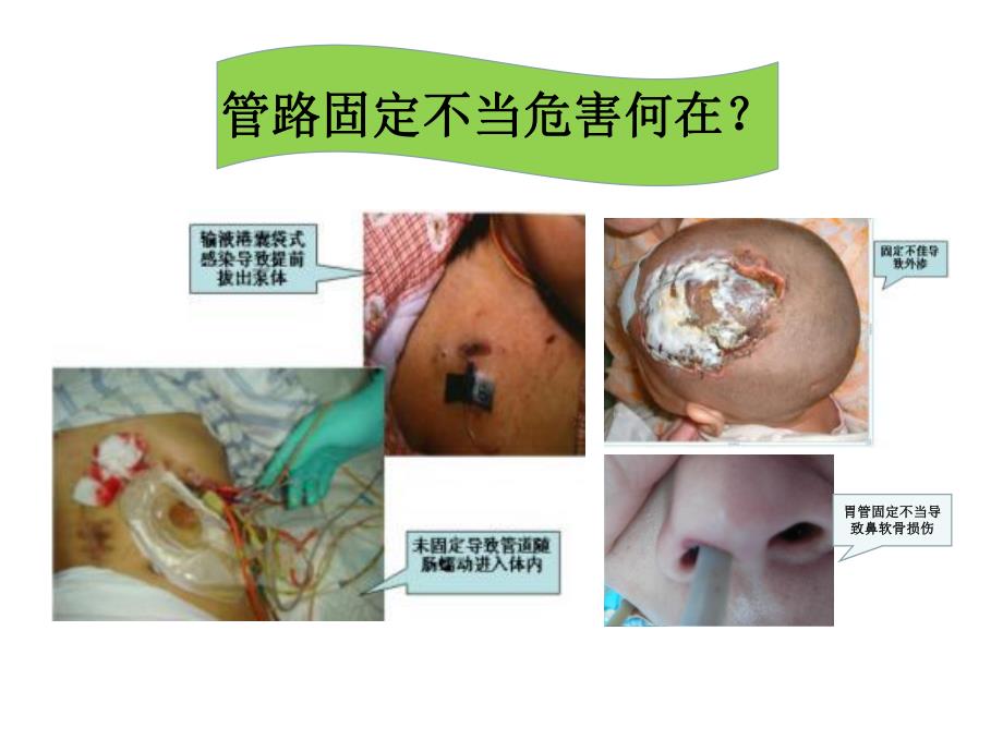 危重患者管路固定.ppt_第2页