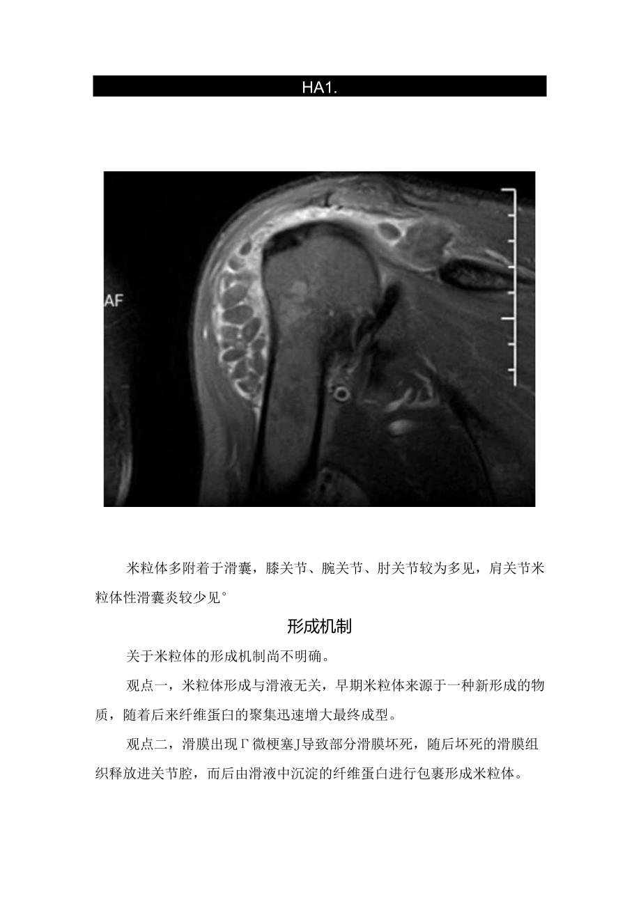 临床米粒体性滑囊炎形成机制、诊断、治疗方法和研究进展.docx_第2页