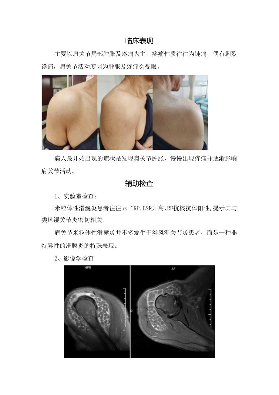 临床米粒体性滑囊炎形成机制、诊断、治疗方法和研究进展.docx_第3页