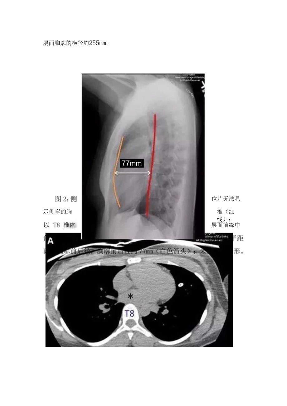 临床直背综合症病理、发生机制、临床表现及X线检查.docx_第2页