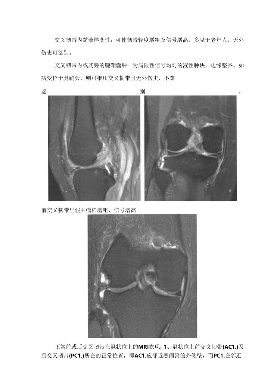 临床膝关节交叉韧带、内外侧副韧带撕裂疾病临床表现.docx_第3页