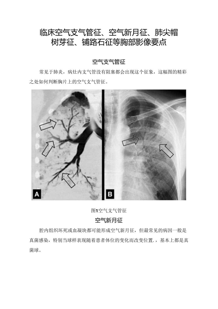 临床空气支气管征、 空气新月征、肺尖帽树芽征、铺路石征等胸部影像要点.docx_第1页