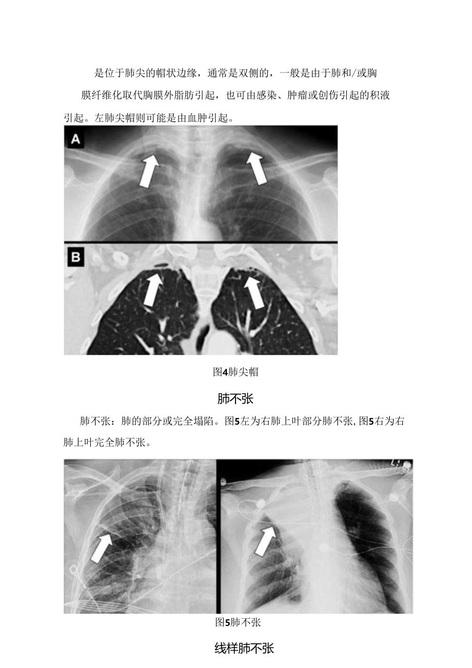 临床空气支气管征、 空气新月征、肺尖帽树芽征、铺路石征等胸部影像要点.docx_第3页