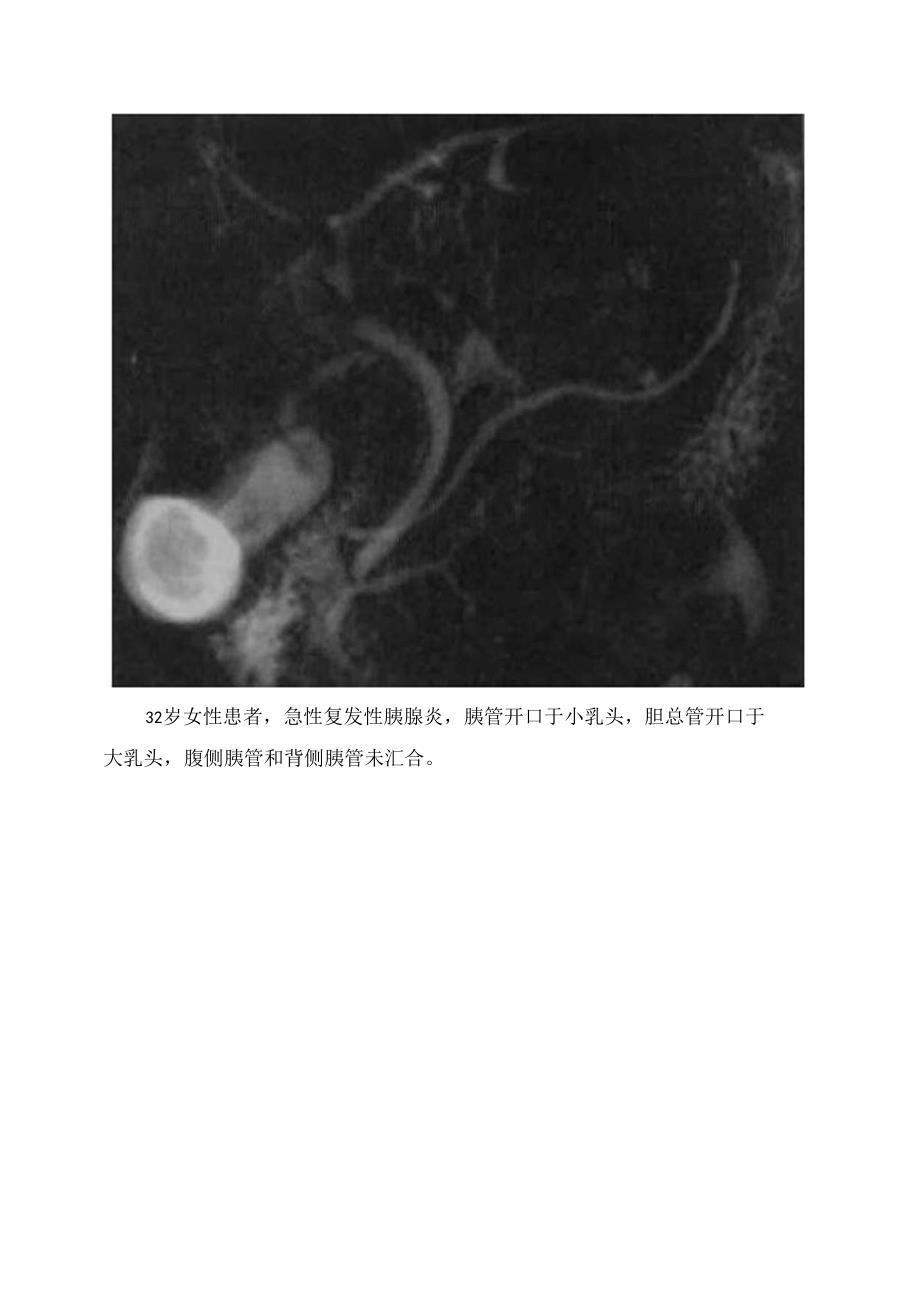 临床胰腺分裂影像诊断.docx_第3页