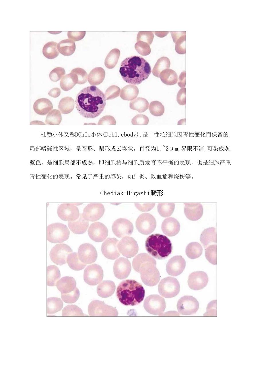 临床检验棒状小体、Chediak-Higashi畸形、中毒颗粒、空泡等白细胞内的“小体”汇总.docx_第2页