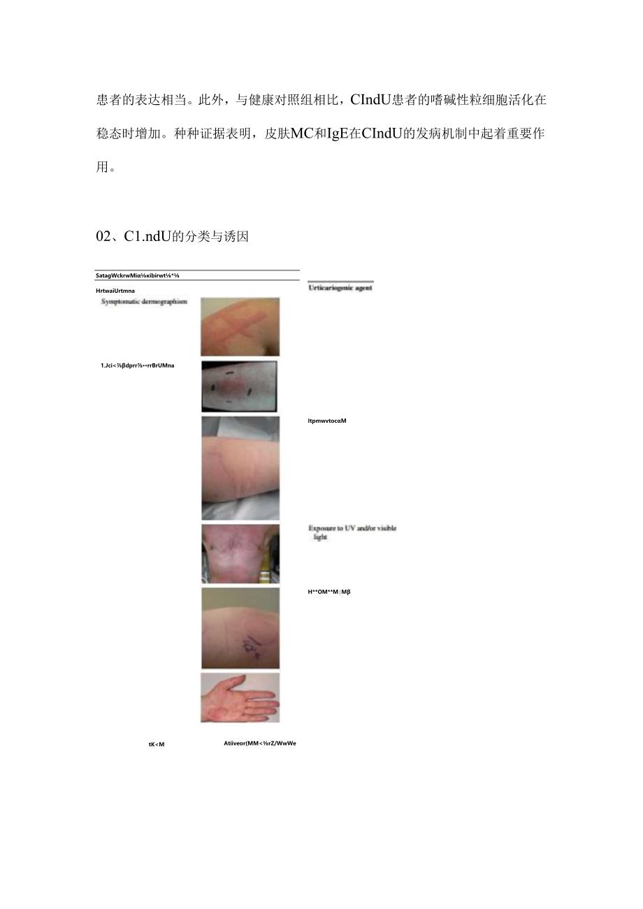 2024慢性诱导性荨麻疹要点（附图表）.docx_第2页