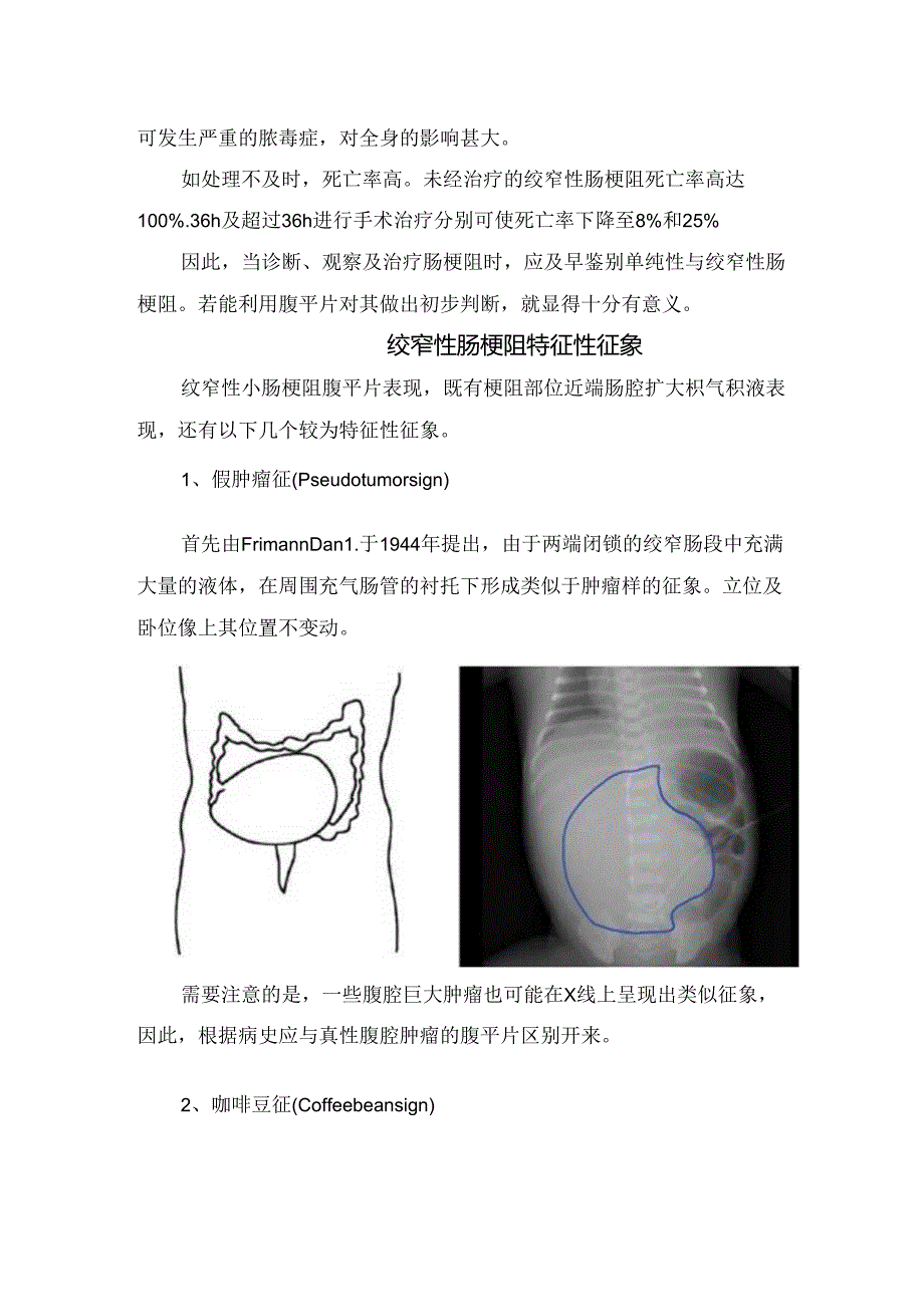 临床小肠梗阻表现、绞窄性肠梗阻特征性征象及生理表现.docx_第2页