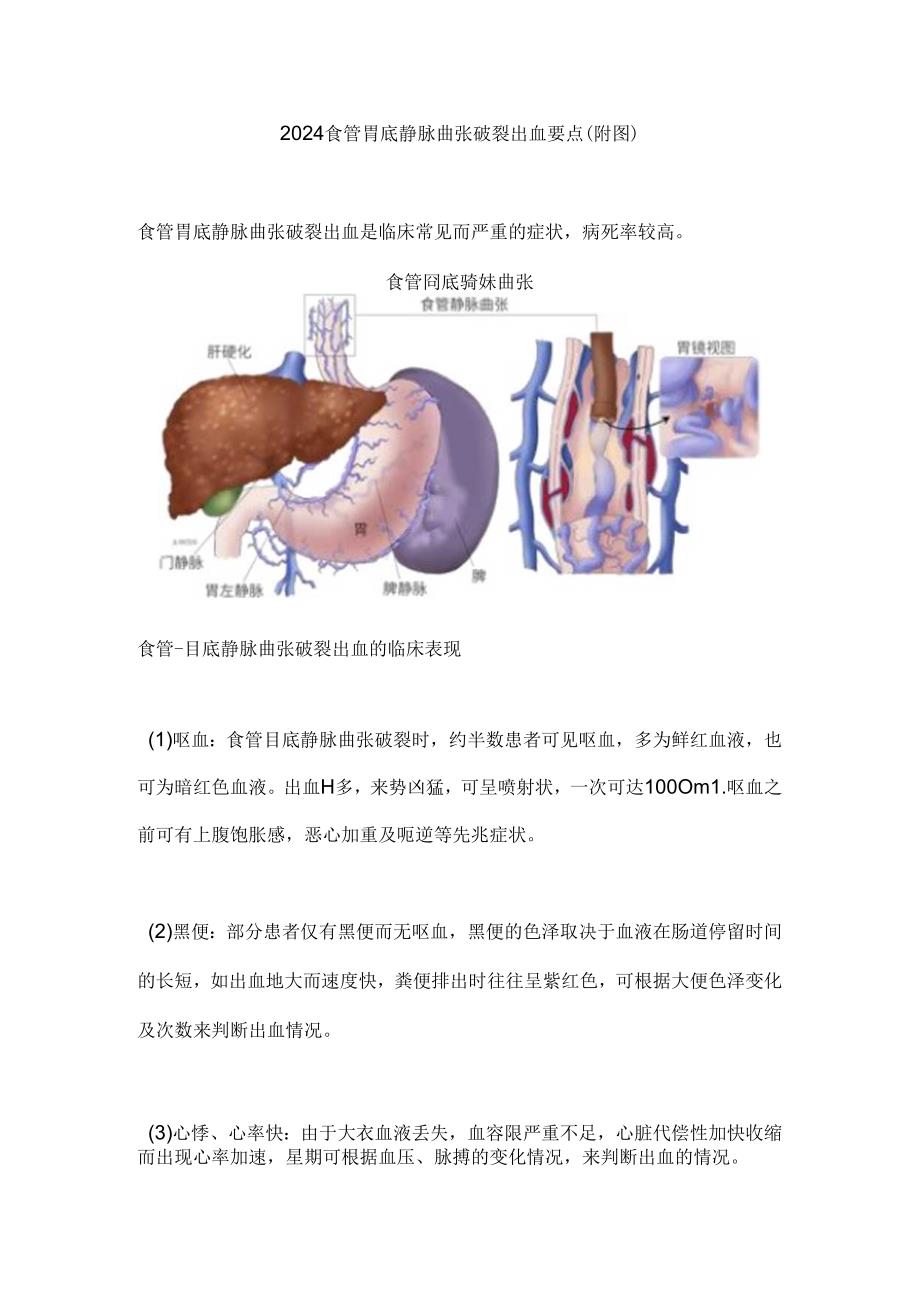 2024食管胃底静脉曲张破裂出血要点（附图）.docx_第1页