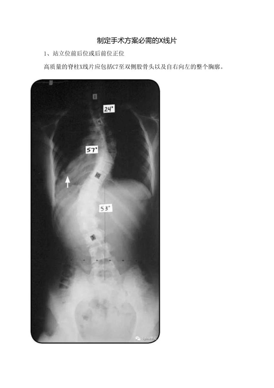 临床脊柱畸形姿势要求及制定手术方案X线片拍摄要求.docx_第2页