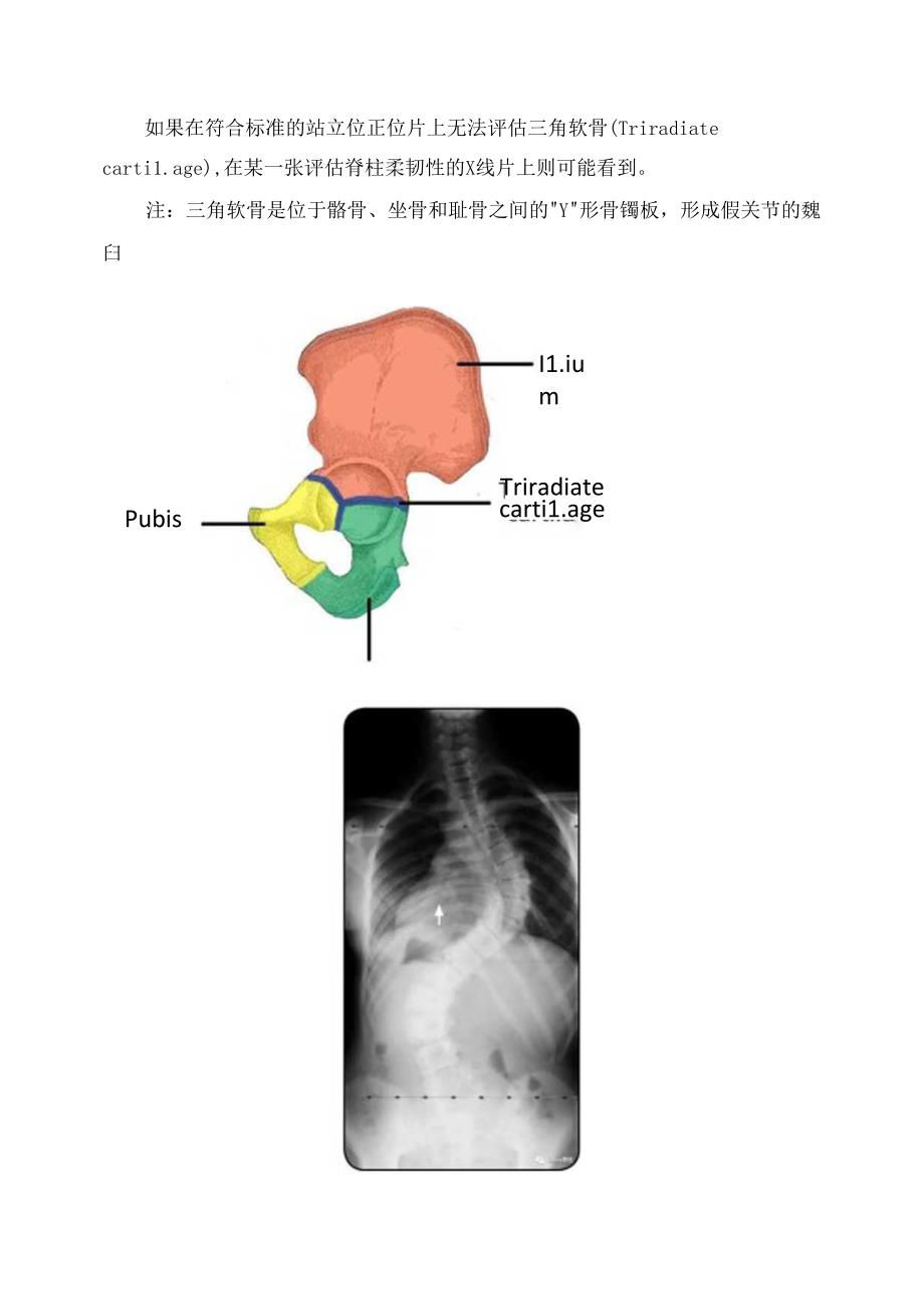 临床脊柱畸形姿势要求及制定手术方案X线片拍摄要求.docx_第3页