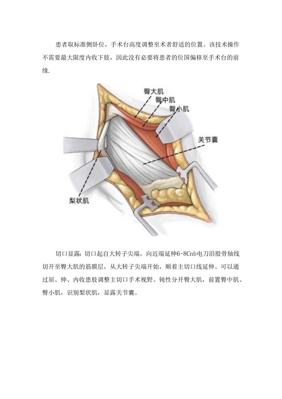 临床SuperPATH 关节置换要点.docx_第2页