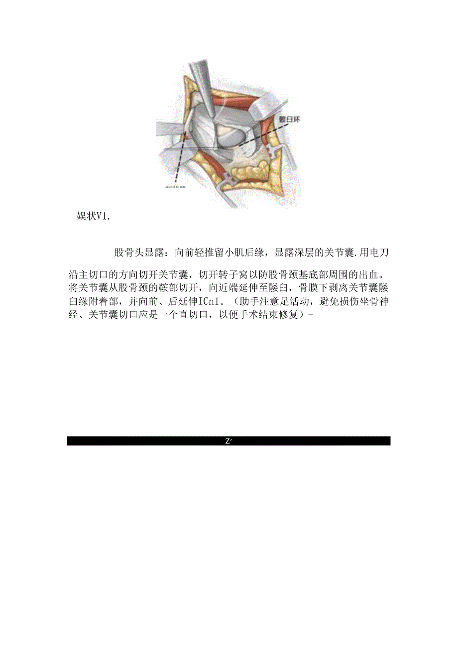 临床SuperPATH 关节置换要点.docx_第3页