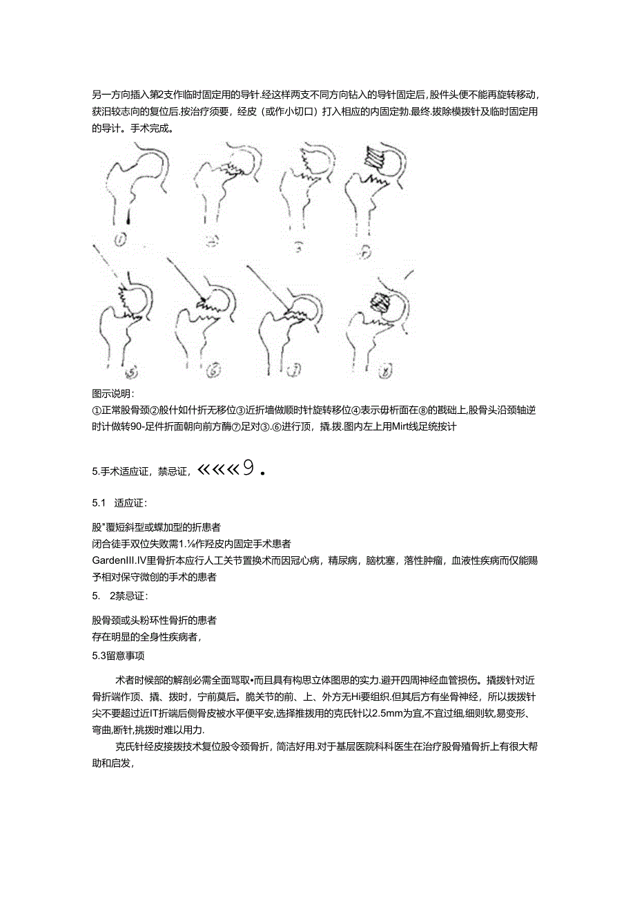 克氏针撬拨技术在闭合复位股骨颈骨折中的运用.docx_第2页