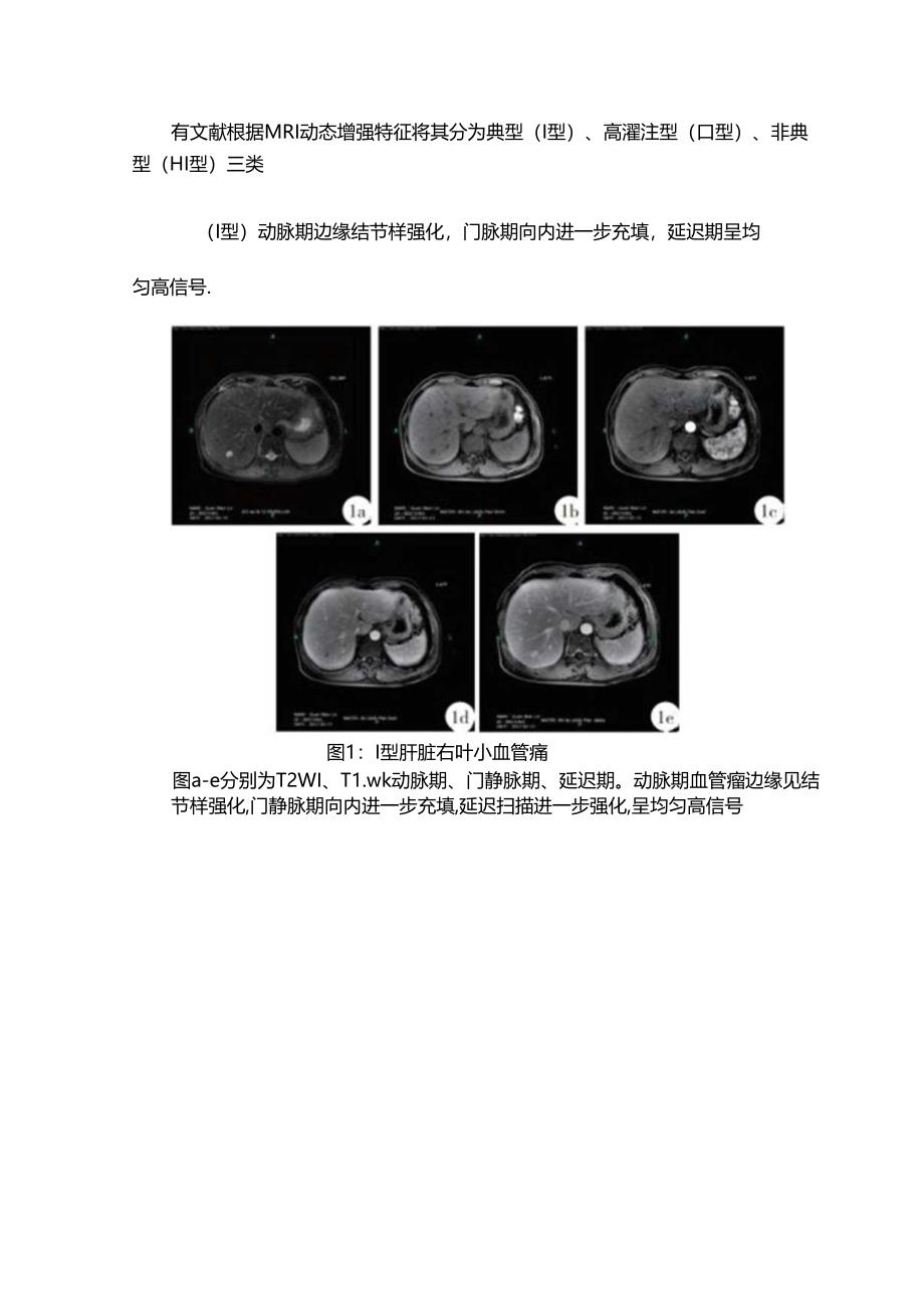 肝微小血管瘤的影像表现.docx_第3页