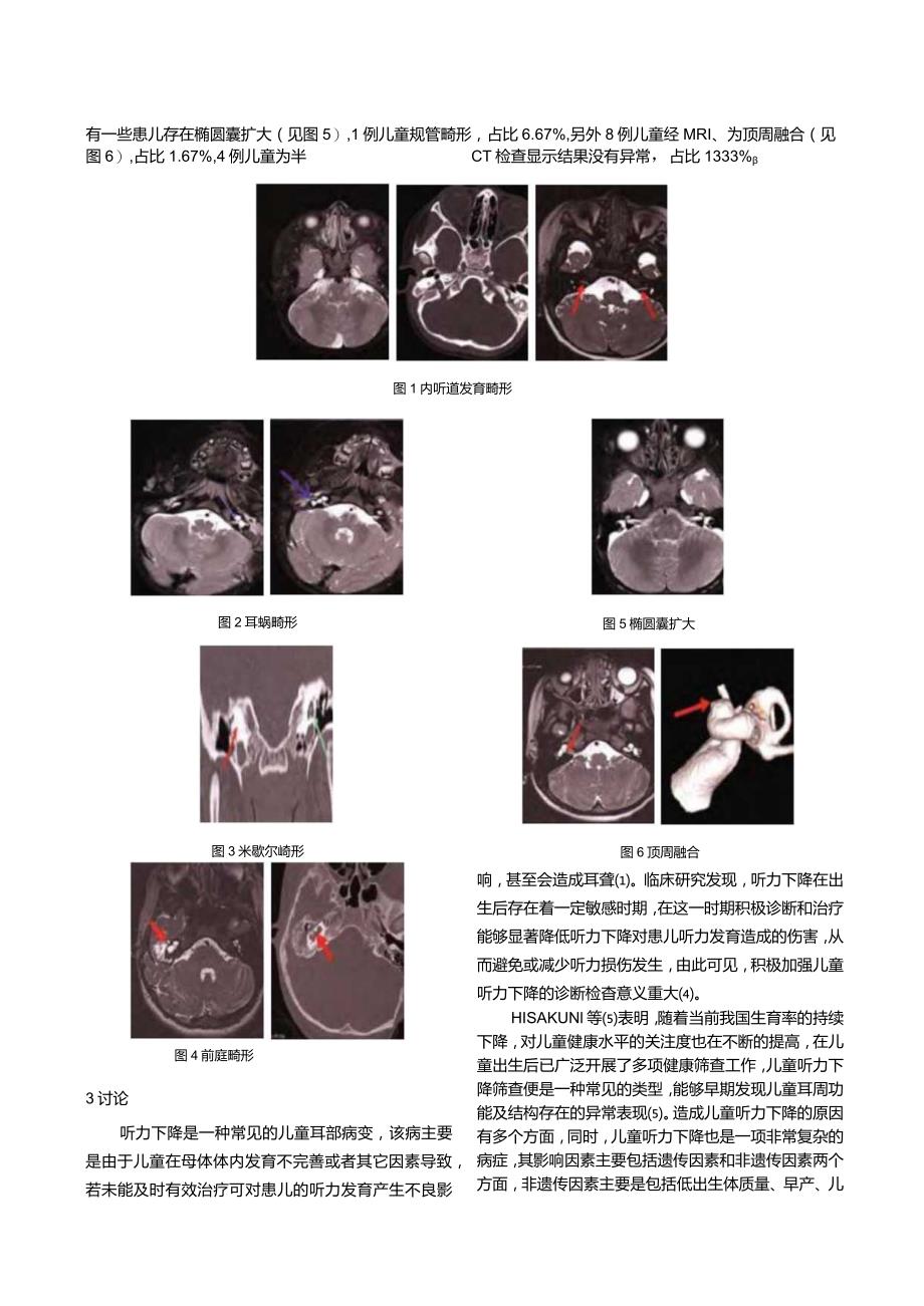 MRI、CT检查对儿童先天...听觉中枢畸形的临床应用价值.docx_第3页