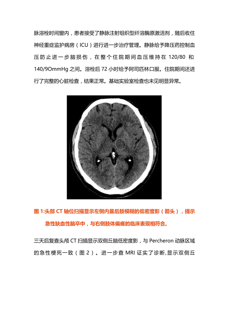 2024罕见的双侧丘脑卒中病因.docx_第2页