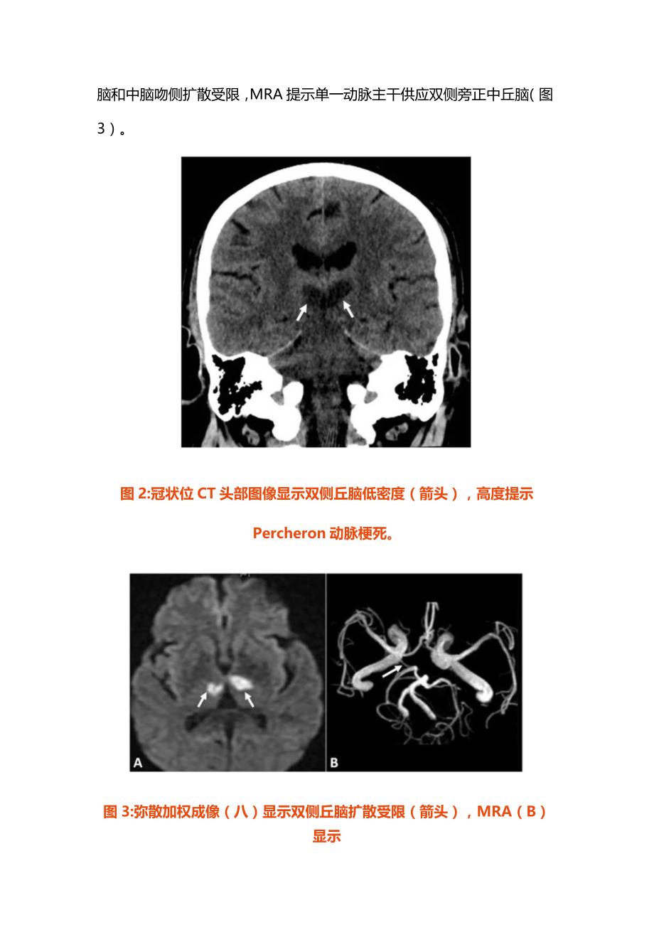 2024罕见的双侧丘脑卒中病因.docx_第3页