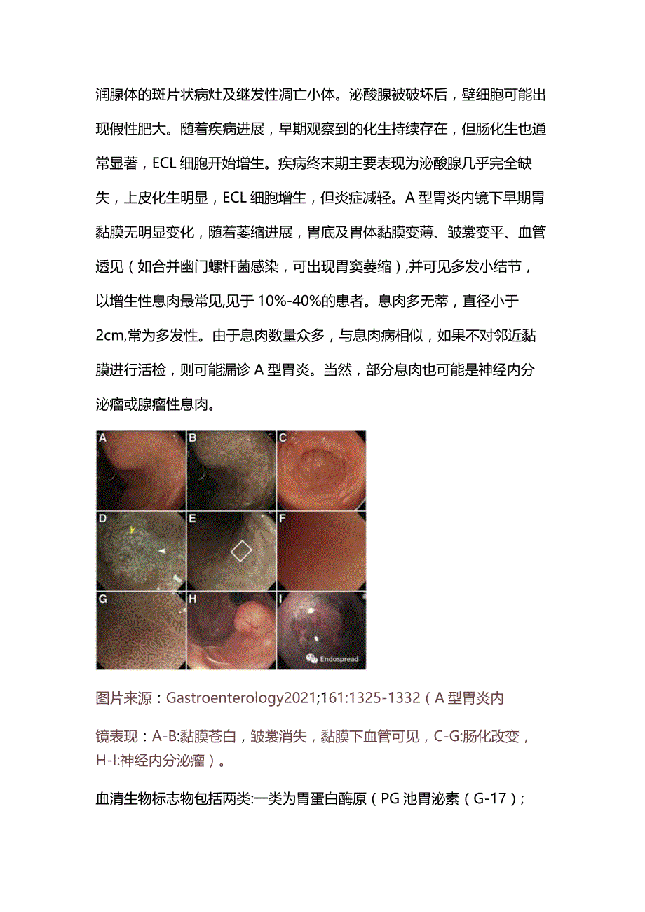 2024自身免疫性胃炎（A型胃炎）.docx_第3页