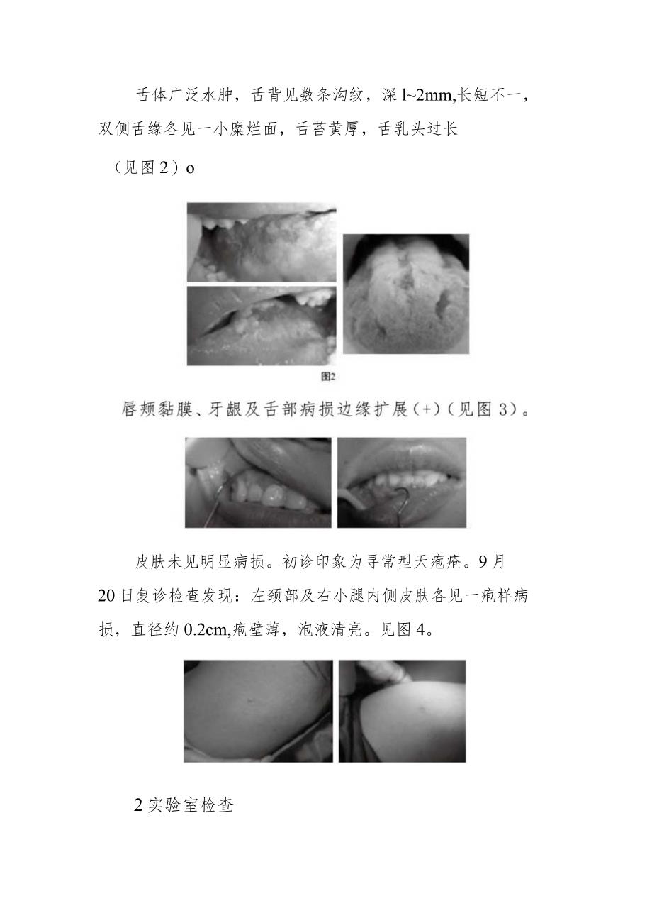 中医黏膜科医师晋升副主任医师病例分析专题报告（寻常型脓疱疮病）.docx_第3页