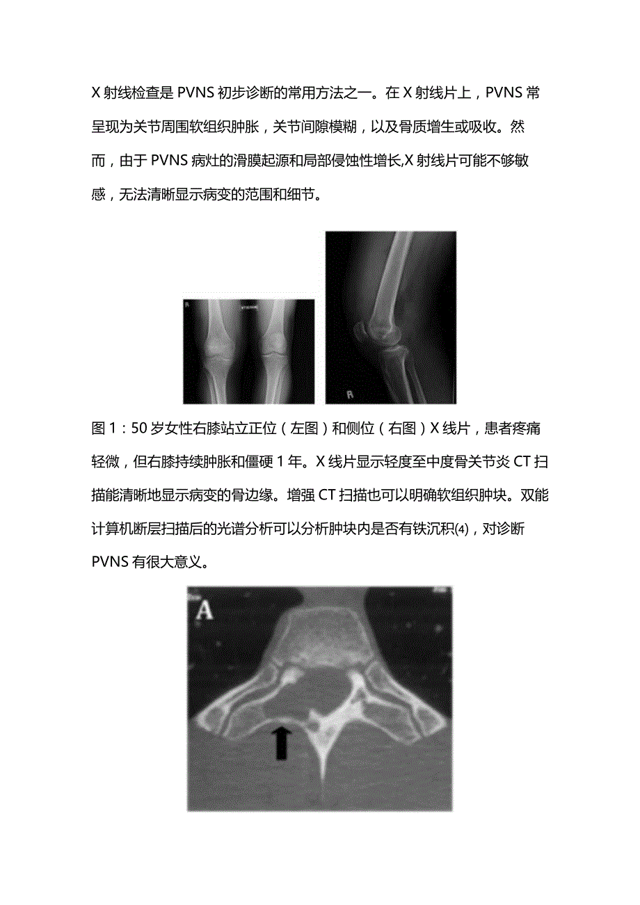 2024色素沉着绒毛结节性滑膜炎诊断与治疗.docx_第3页