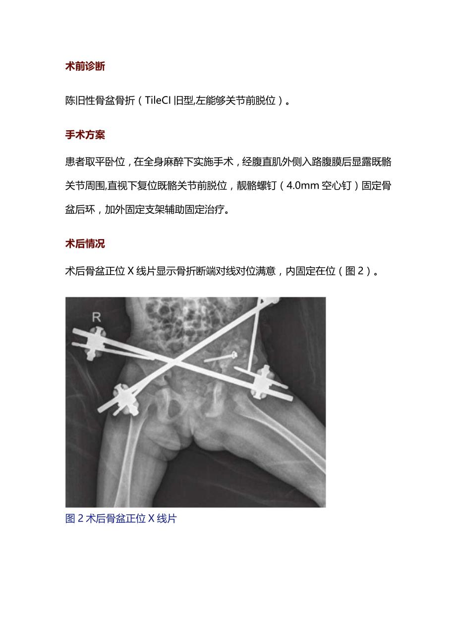 2024儿童骨盆骨折诊疗处理要点.docx_第3页