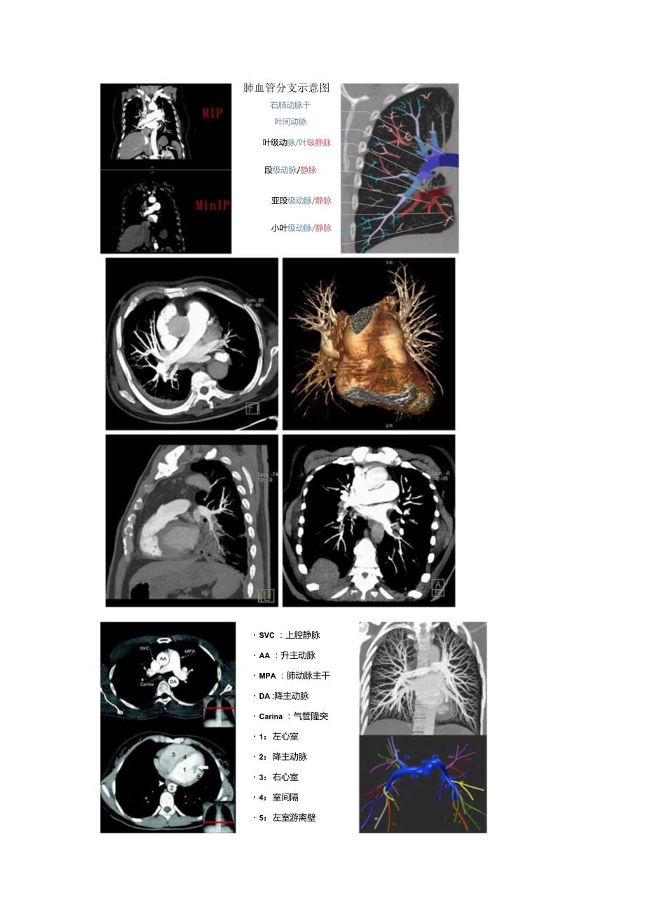CT肺动脉造影诊断策略、影像学表现征象及伪像要点.docx_第2页