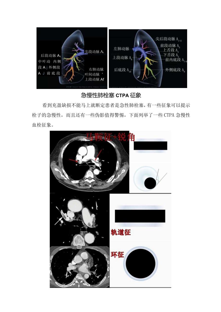 CT肺动脉造影诊断策略、影像学表现征象及伪像要点.docx_第3页