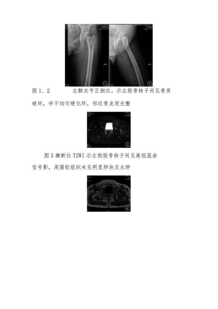 医学影像科股骨真菌感染的影像表现病例分析专题报告.docx_第3页