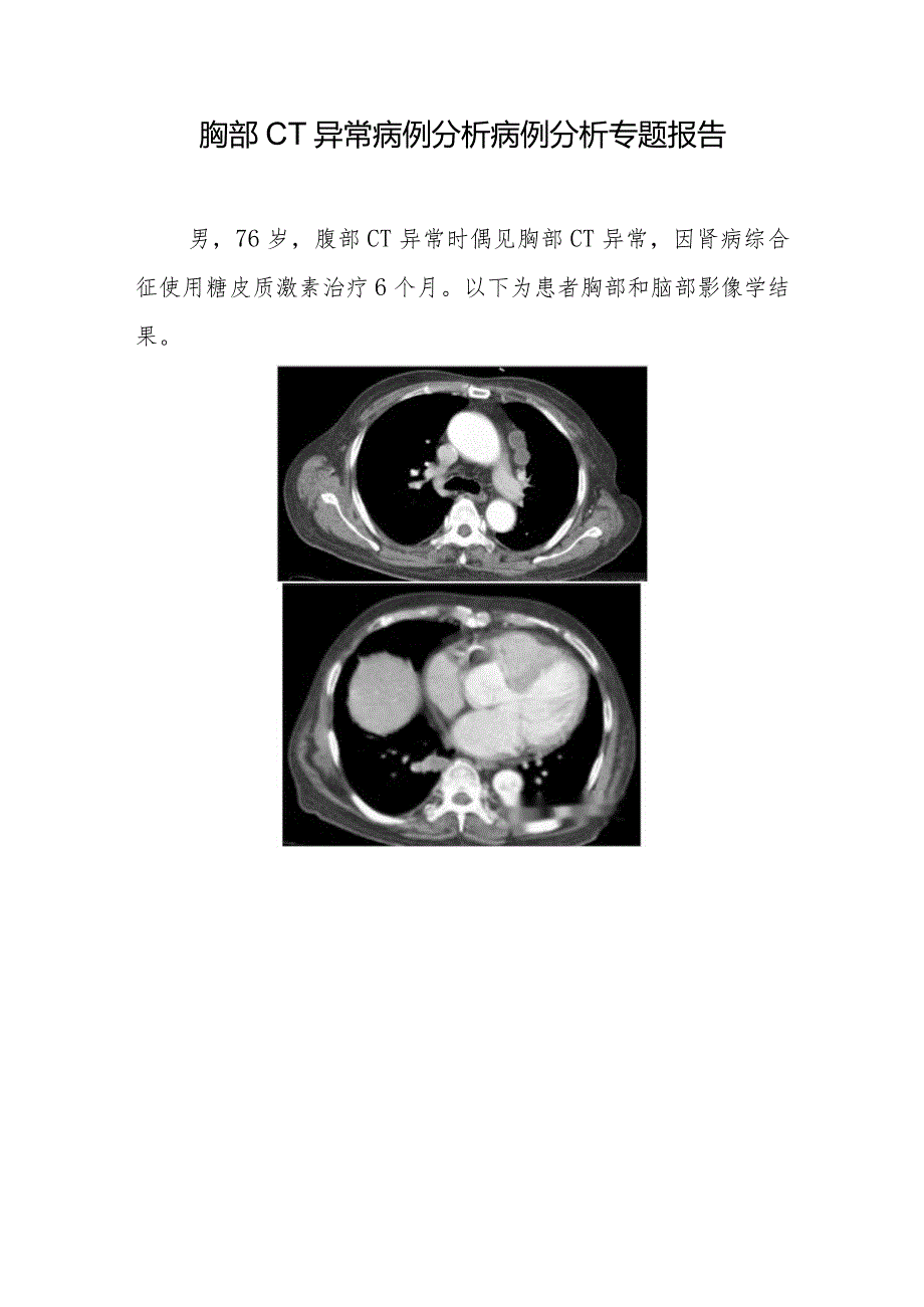 放射科医师晋升副主任医师病例分析专题报告（胸部CT异常病例）.docx_第2页