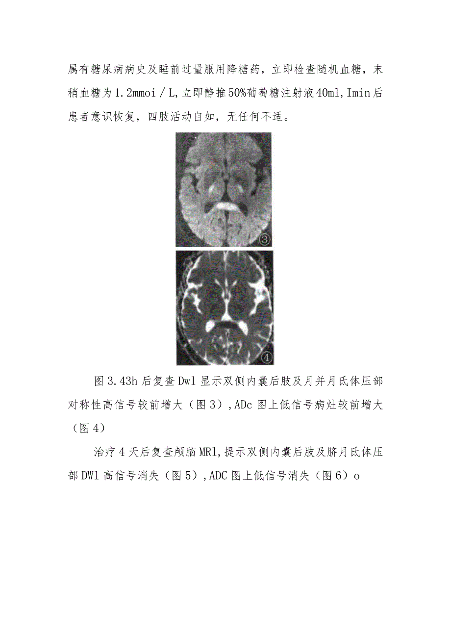 放射科医师晋升副主任医师病例分析专题报告（MRI诊断低血糖脑病）.docx_第3页