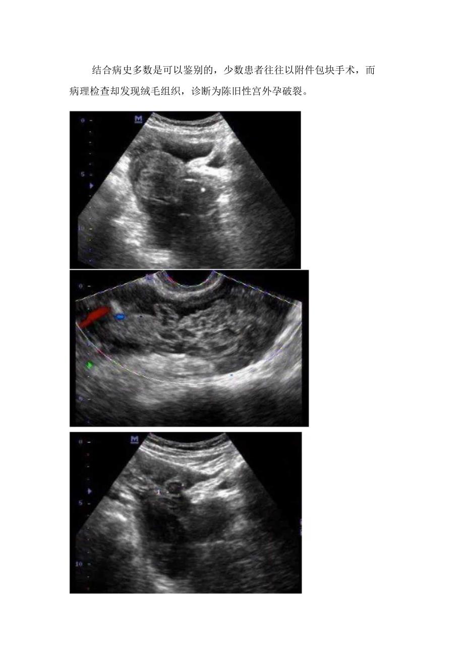 黄体破裂与宫外孕破裂临床表现、病理生理及检查方法及鉴别.docx_第3页