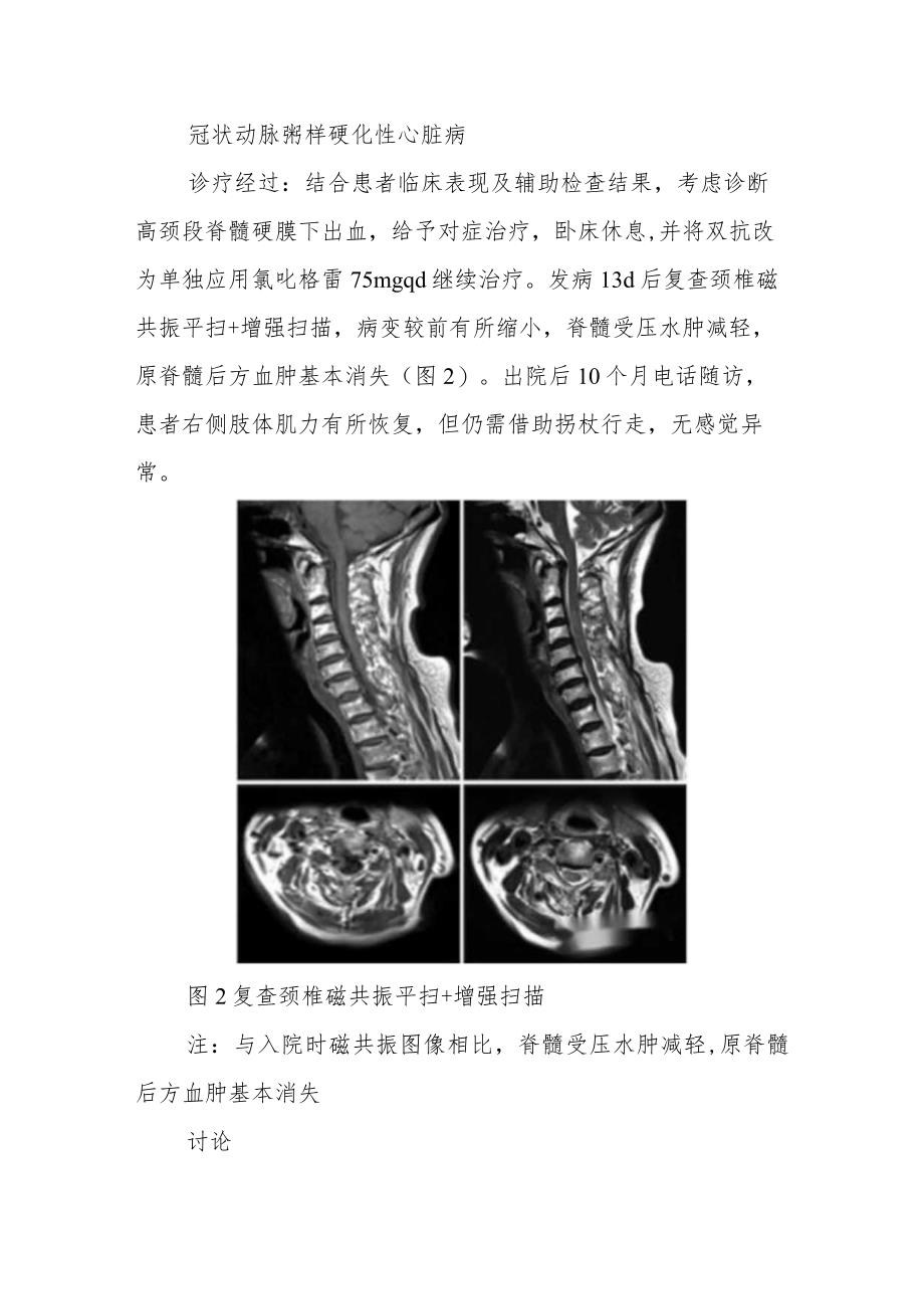 神经内科出血性疾病千万别误诊为脑梗死病例分析专题报告.docx_第3页