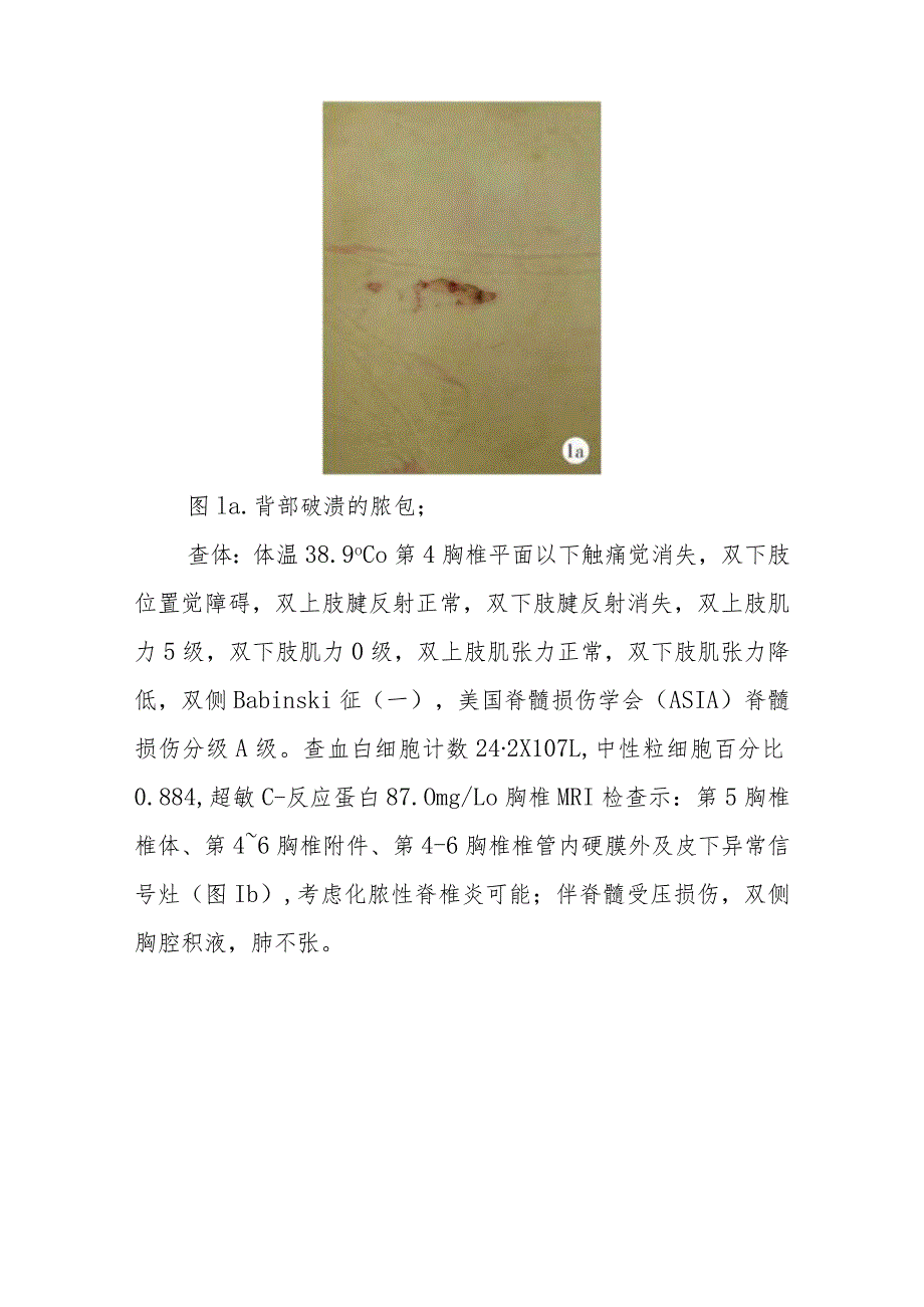 脊柱外科医师晋升副主任医师病例分析专题报告（患者背部疼痛病）.docx_第3页