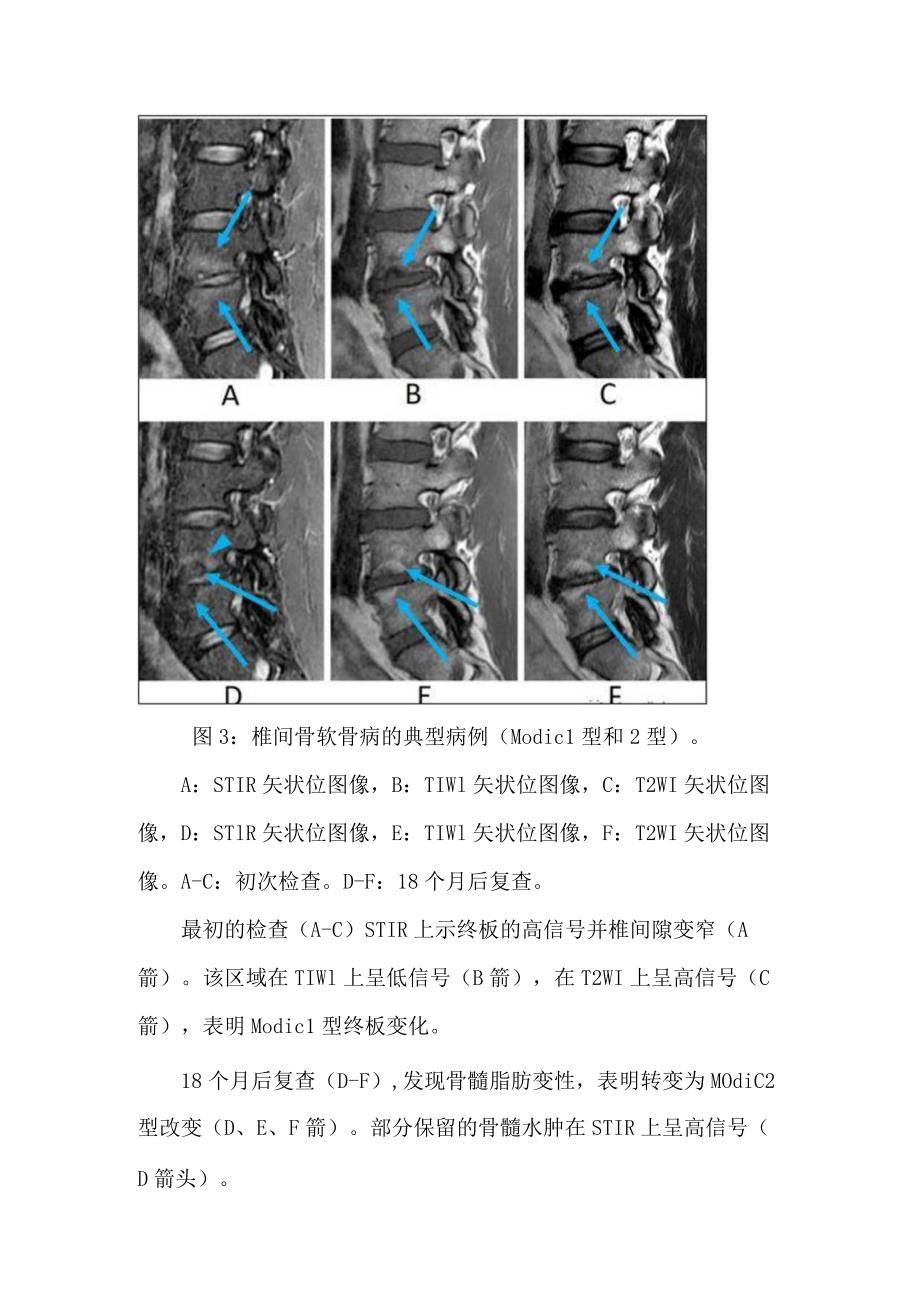 椎间骨软骨病临床表现及影像学表现.docx_第2页