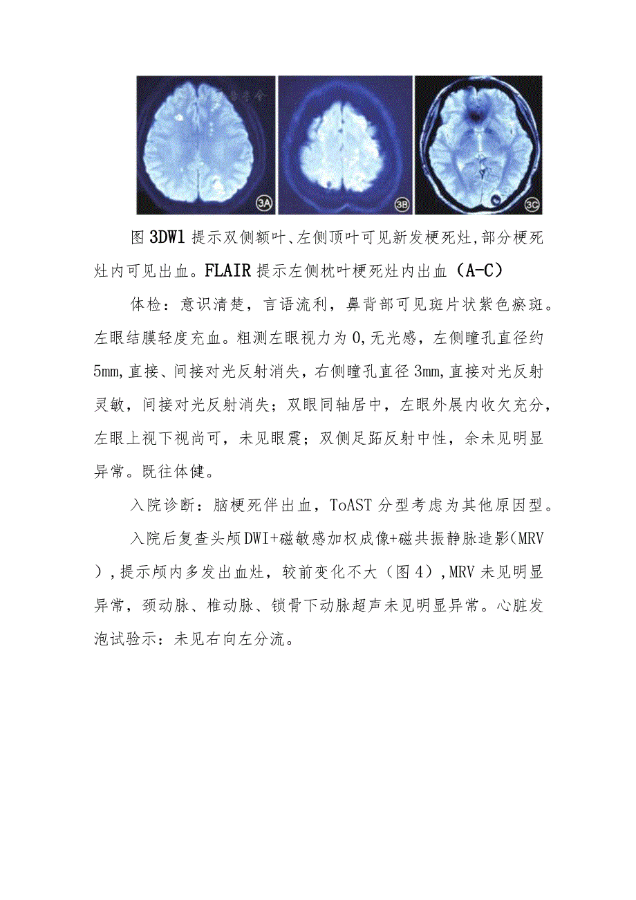 神经内科因隆鼻引起脑梗死和左眼失明病例分析专题报告.docx_第3页