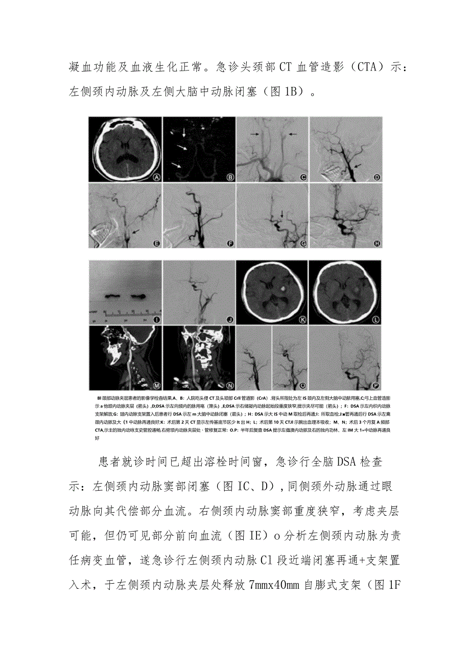 神经内科医师晋升副主任医师病例分析专题报告（突发右侧肢体无力伴言语不清病）.docx_第3页