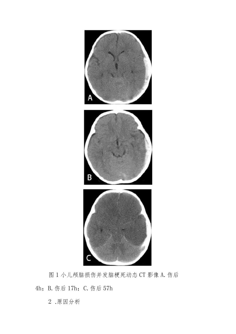 神经内科小儿颅脑损伤后并发大面积脑梗死病例分析专题报告.docx_第2页