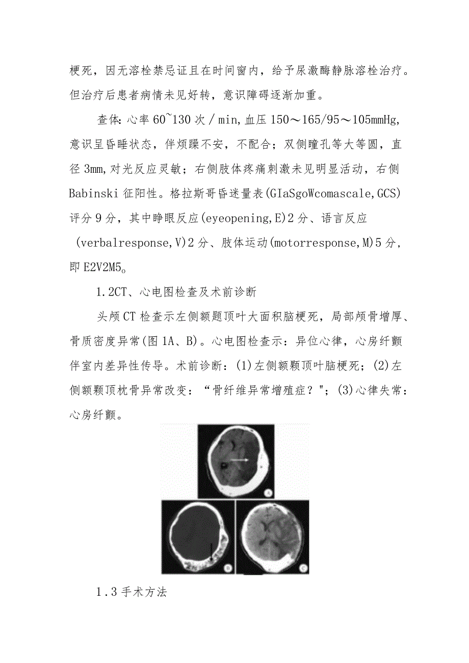 神经外科颅盖部巨大骨纤维异常增殖症合并大面积脑梗死去骨瓣减压术病例分析专题报告.docx_第2页