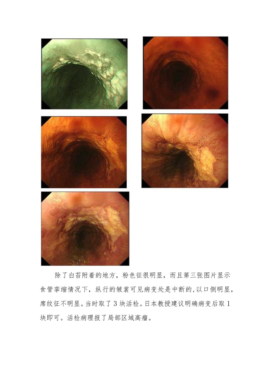 胸外科医师晋升副主任医师病例分析专题报告（食管浅表癌病）.docx_第3页