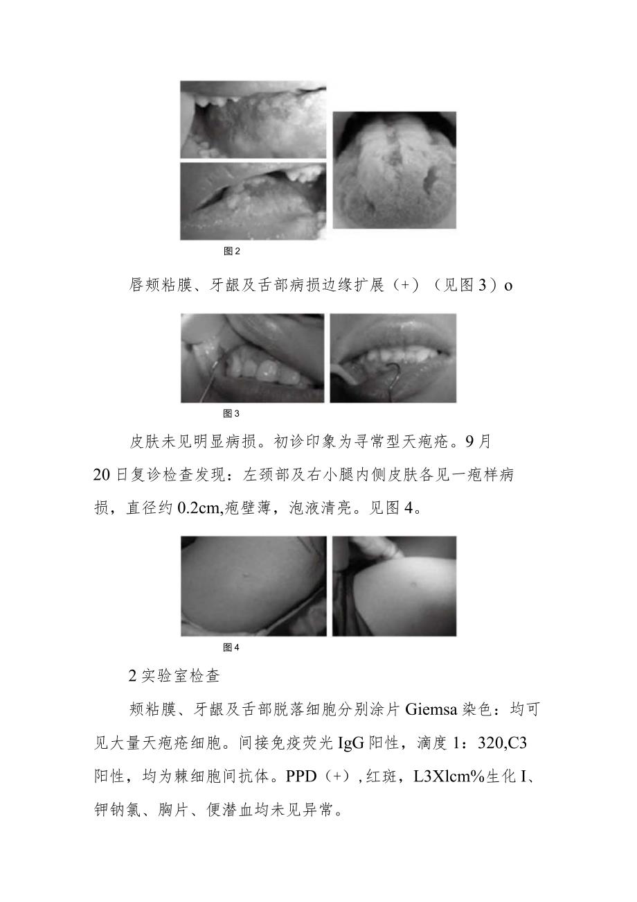 皮肤科寻常型天疱疮病例分析专题报告.docx_第2页