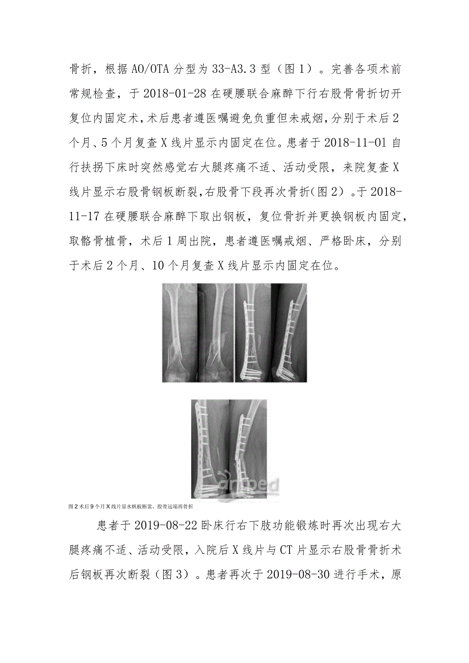 骨科股骨远端骨折内固定术后顽固性骨折不愈合病例分析.docx_第2页