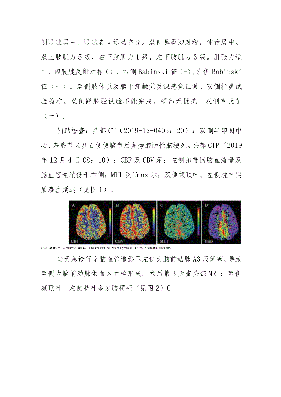 医学影像科CT灌注成像早期诊断双侧大脑前动脉供血区脑梗死病例分析专题报告.docx_第2页